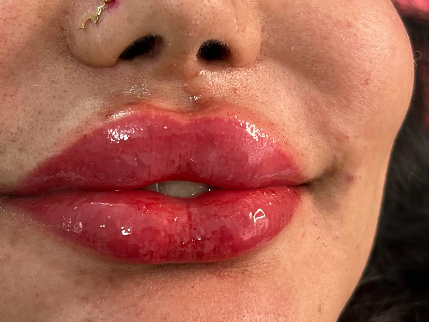 تزریق ژل و بوتاکس لیزر موهای زای|خدمات زیبایی و سلامت|تهران, نازیآباد|دیوار
