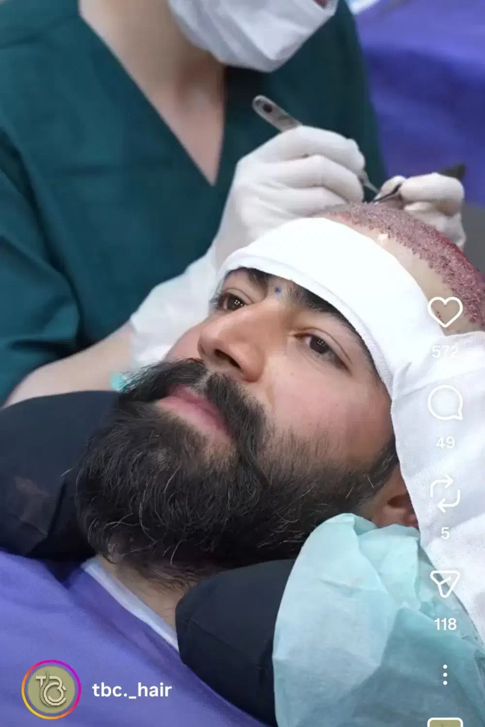 بلفاروبلاستی/کاشت مو/کاشت ابرو/کاشت ریش/عمل بینی|خدمات آرایشگری و زیبایی|همدان, |دیوار