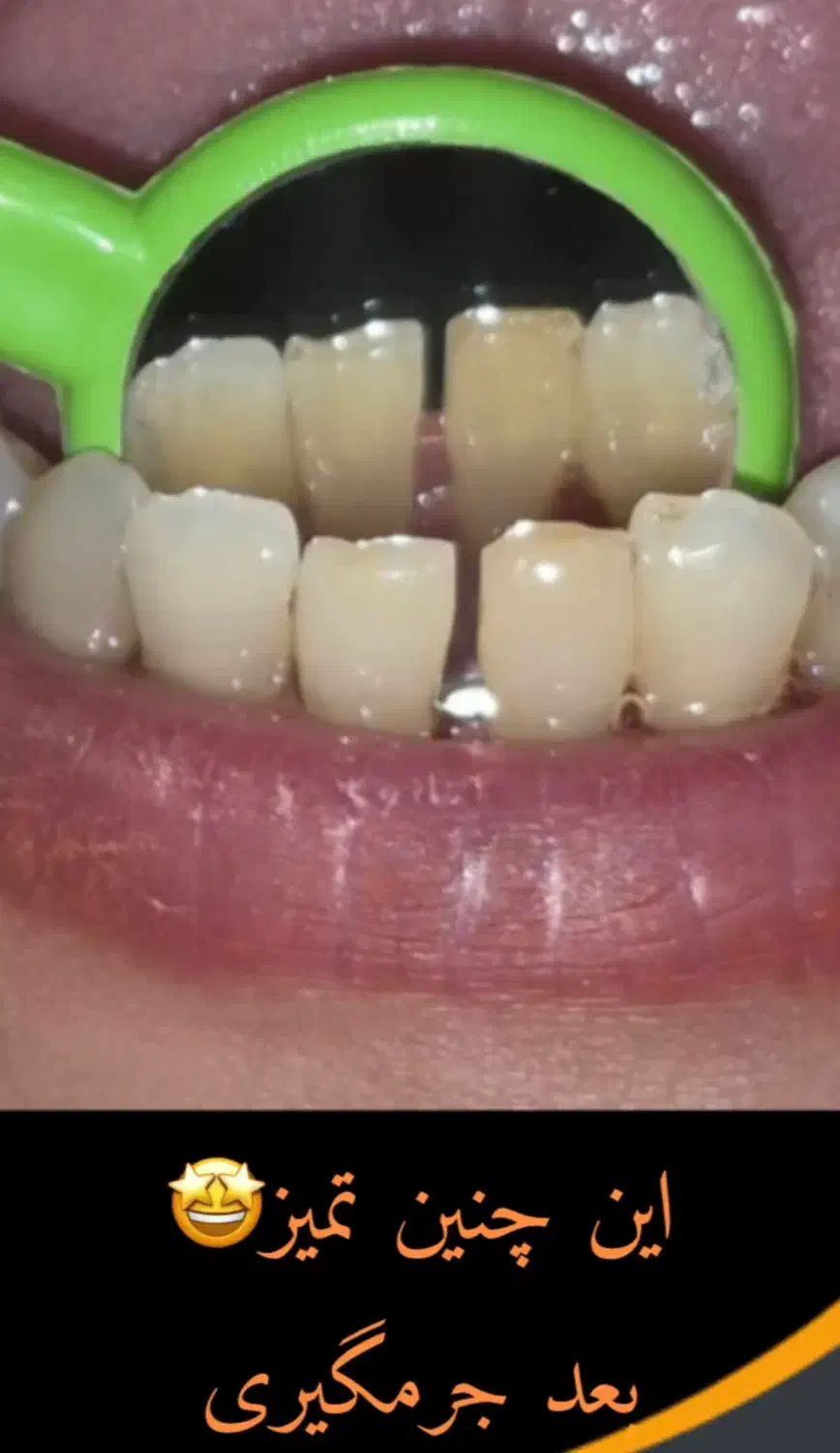 تخفیف ویژه جرمگیری تا ۱۵ آذر فقط ۱۸۰۰|خدمات آرایشگری و زیبایی|رشت, گلسار|دیوار