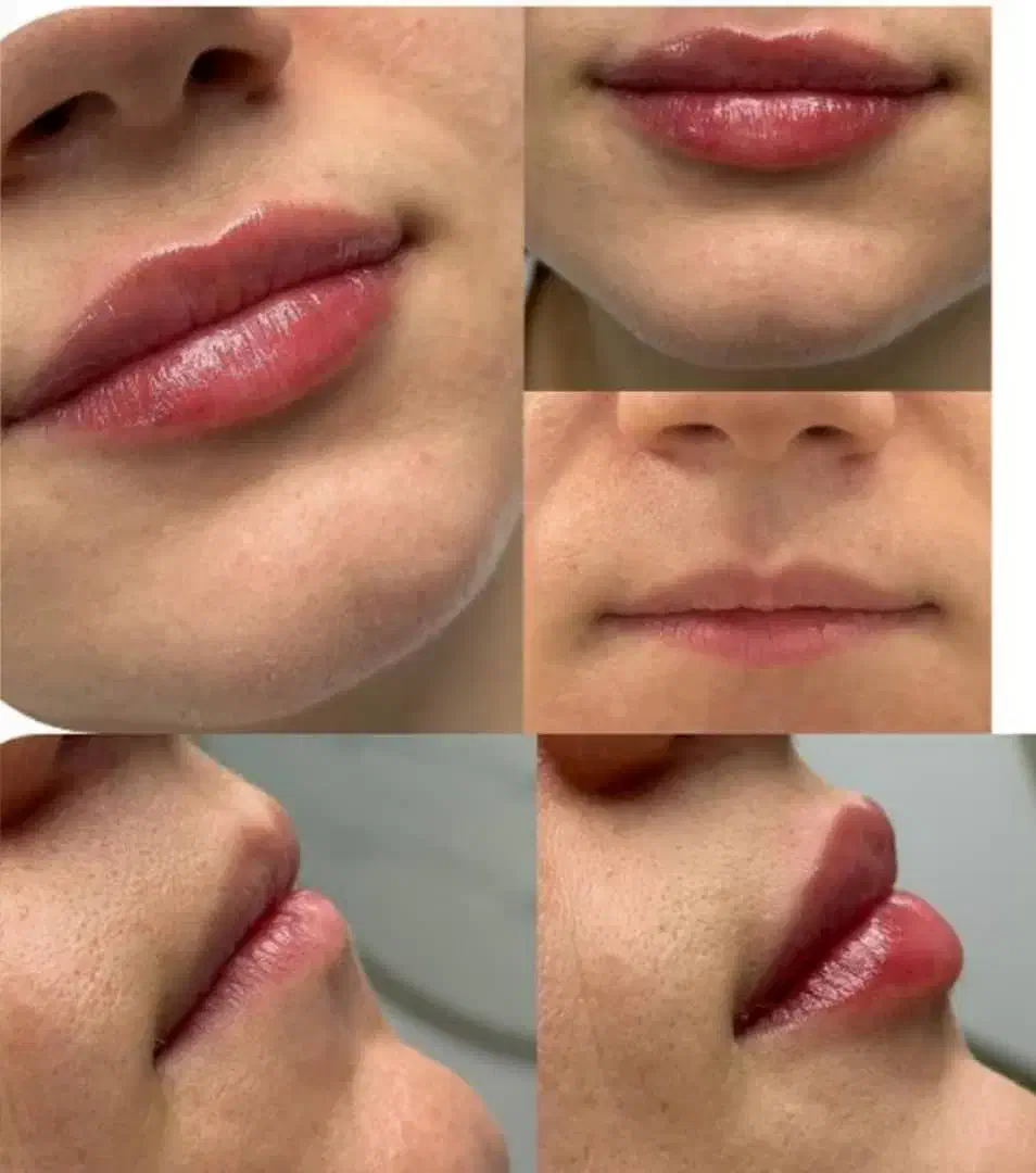 انجام ژل و بوتاکس با بهترین مواد اقساطی|خدمات آرایشگری و زیبایی|آزادشهر, |دیوار