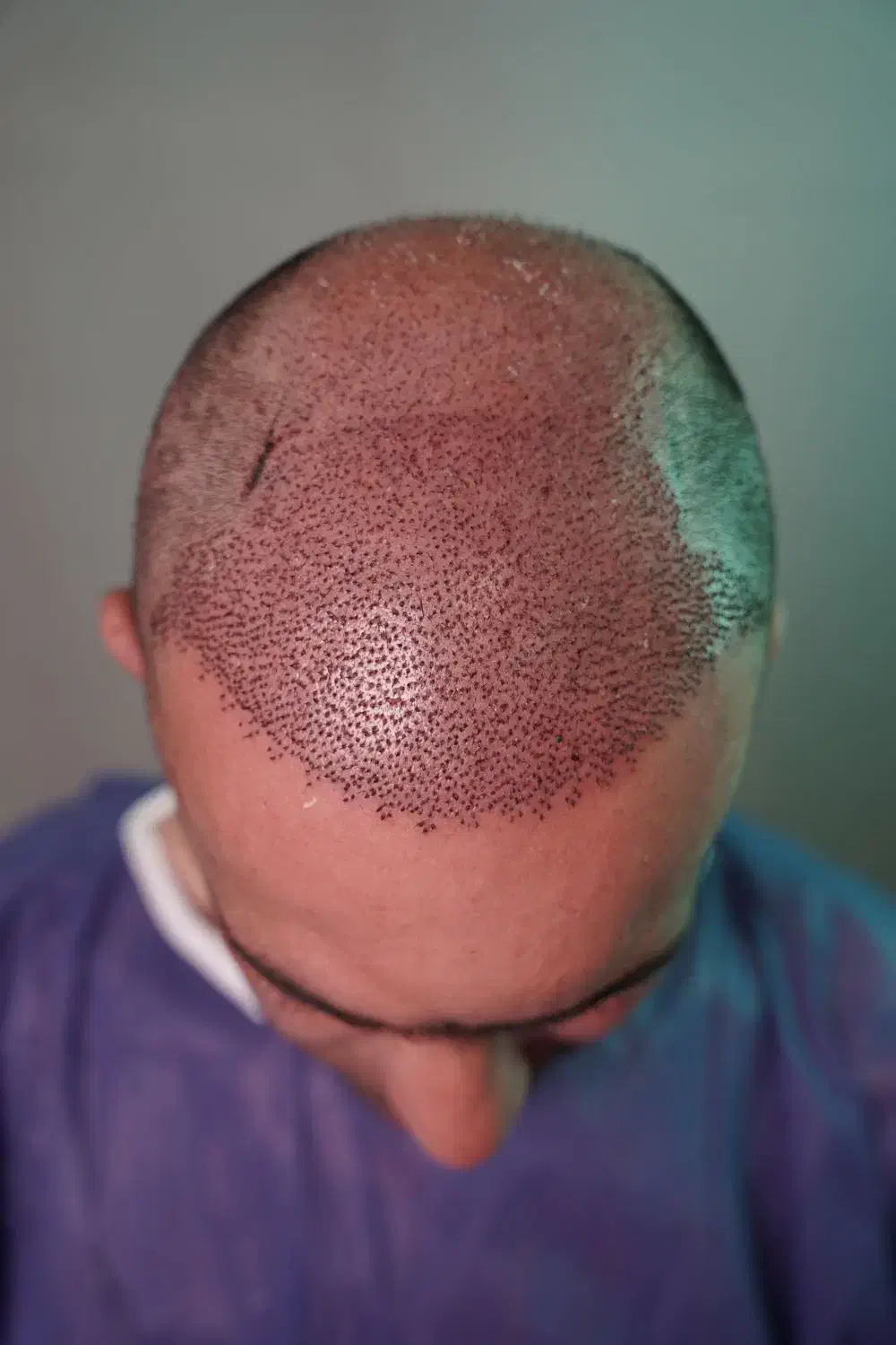 کاشت مو|خدمات آرایشگری و زیبایی|سقز, |دیوار