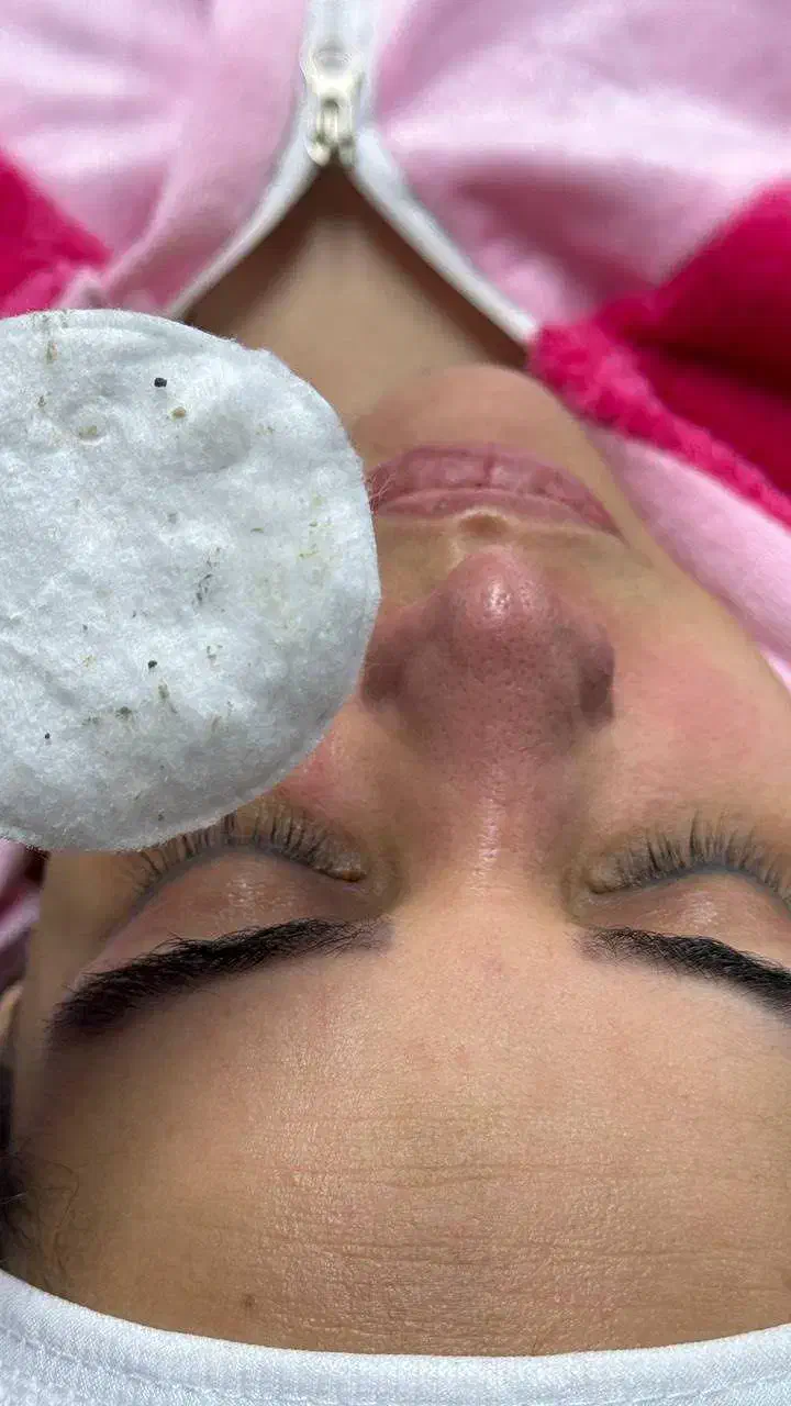 درماپلینیگ درما پاکسازی|خدمات آرایشگری و زیبایی|زابل, |دیوار