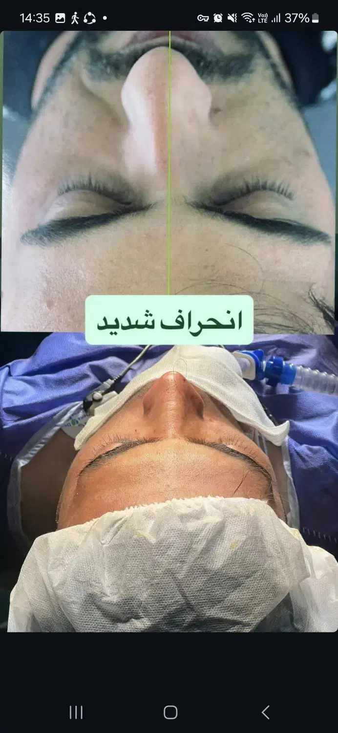 عمل بینی/جراحی بینی|خدمات آرایشگری و زیبایی|لار, |دیوار