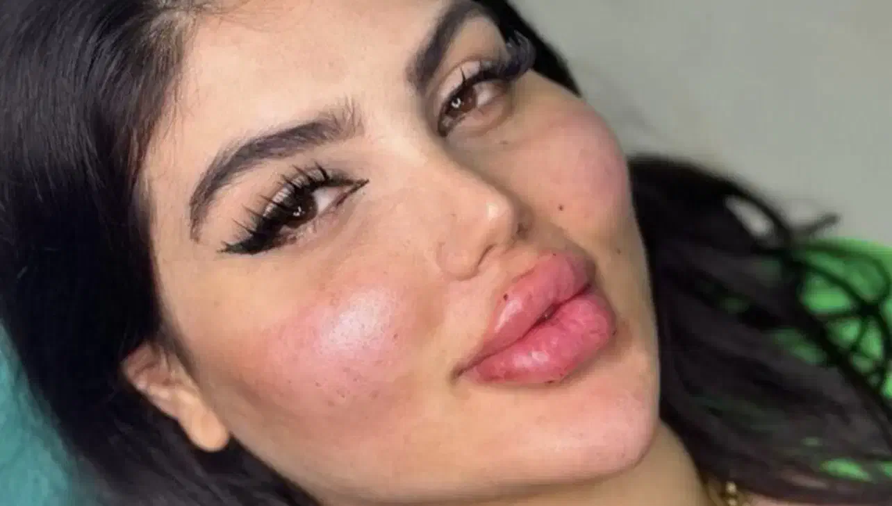 تخفیف ژل و فیلر فول فیس 3900 به جای ۷/۹۰۰|خدمات آرایشگری و زیبایی|اصفهان, خانه اصفهان|دیوار