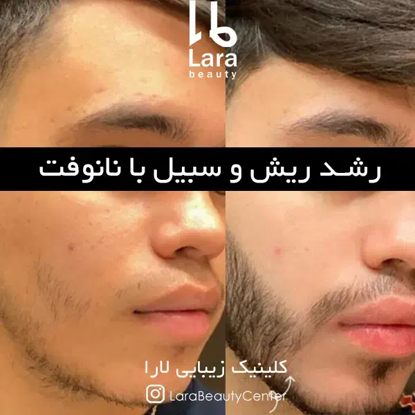 پی آر پیPRP درمان ریزش مو مزوتراپی هیرفیلر کاشت مو|خدمات آرایشگری و زیبایی|تهران, صادقیه|دیوار