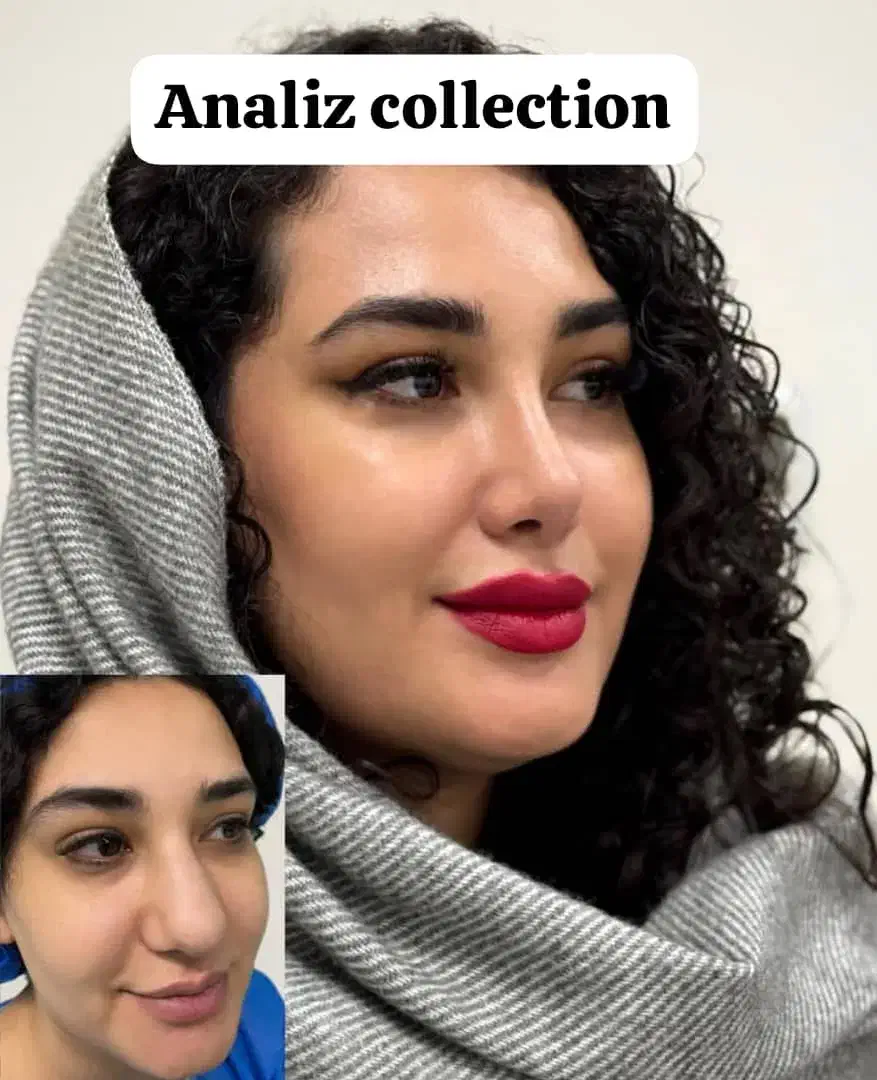 عمل بینی/پلک بلفارو/کاشت مو/دندان/غبغب لیپوابدو|خدمات آرایشگری و زیبایی|شیراز, معالی‌آباد|دیوار