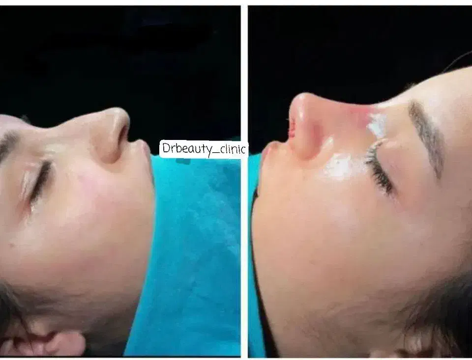 بلک‌فرایدی تخفیف ویژه روی عمل بینی بابهترین جراحان|خدمات آرایشگری و زیبایی|ری, علایین|دیوار