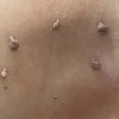 رفع منگوله و ضایعات پوستی|خدمات آرایشگری و زیبایی|زنجان, |دیوار