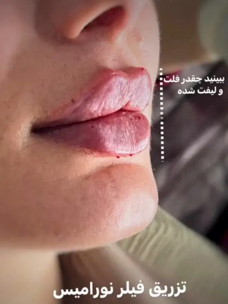تزریق ژل و بوتاکس توسط پیرا پزشک مجرب|خدمات آرایشگری و زیبایی|اهواز, پادادشهر|دیوار