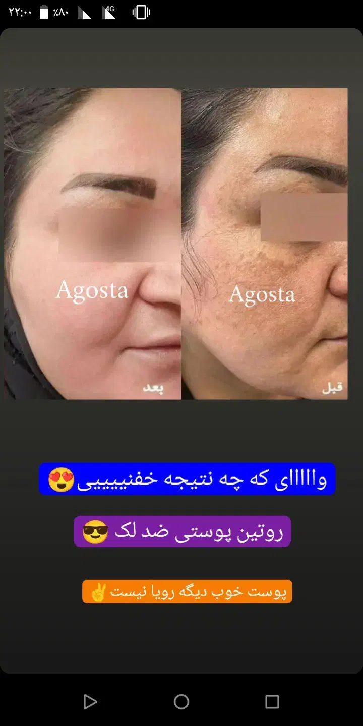 سرم نیاسینامید ضد لک وجوش|آرایشی، بهداشتی، درمانی|شیراز, باغ تخت|دیوار