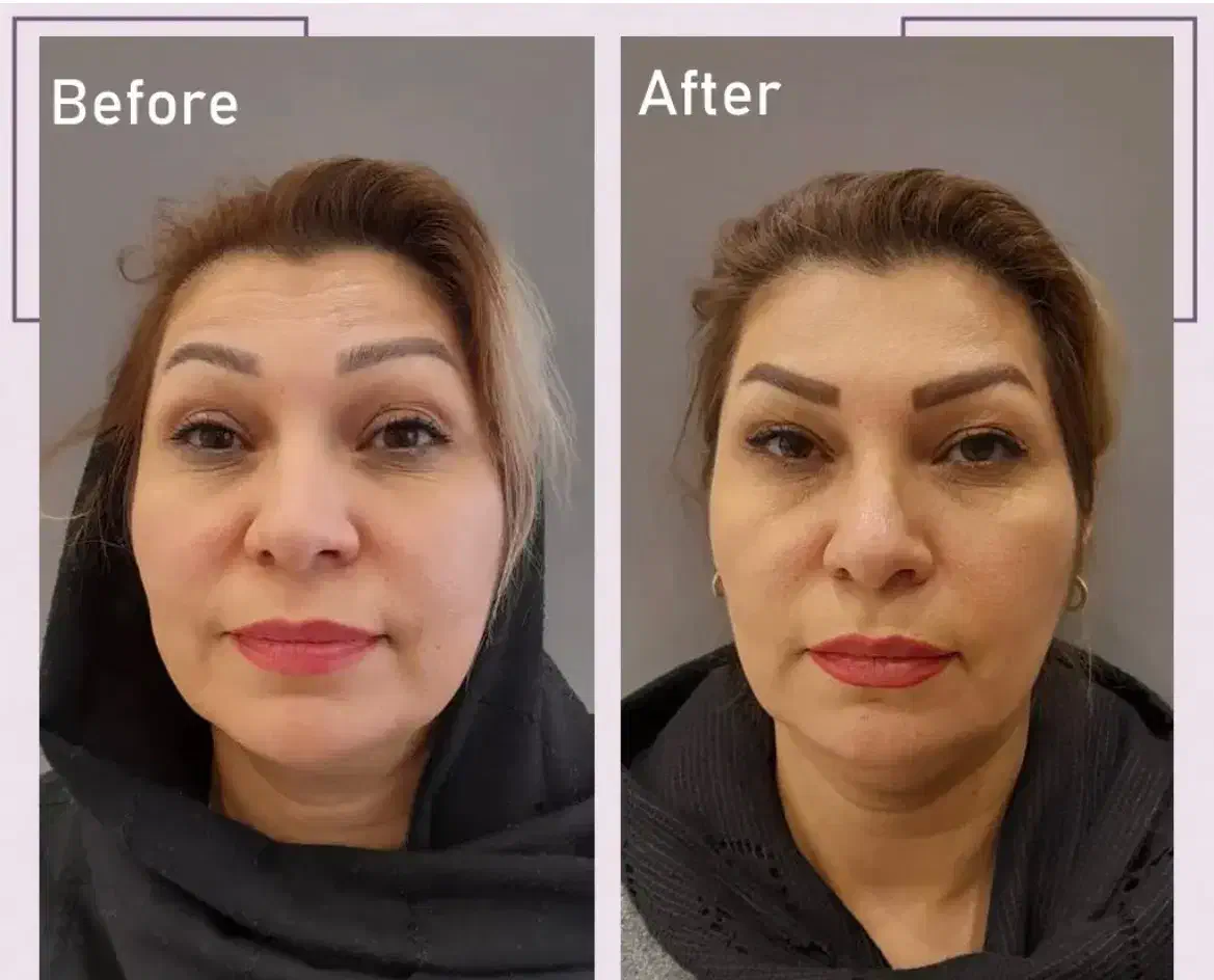 آکادمی تخصصی بوتاکس|خدمات آرایشگری و زیبایی|شیراز, قدوسی غربی|دیوار