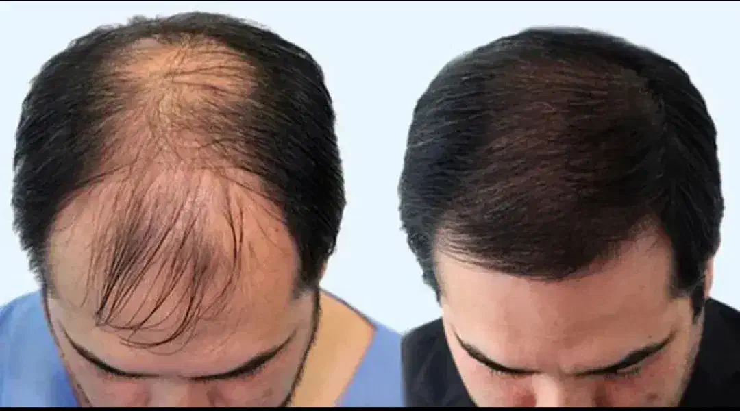 کاشت مو و ابرو|خدمات آرایشگری و زیبایی|بوشهر, |دیوار