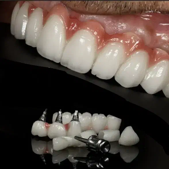 شرایط ویژه جشنواره دندانپزشکی ایمپلنت اوردنچر روکش|خدمات آرایشگری و زیبایی|تبریز, |دیوار