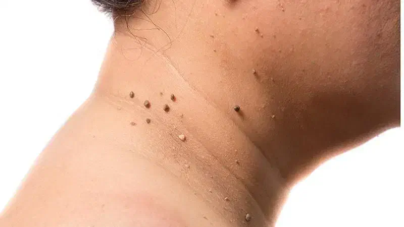 زگیل خال گوشتی و مخچه و...|خدمات آرایشگری و زیبایی|سرپل ذهاب, |دیوار
