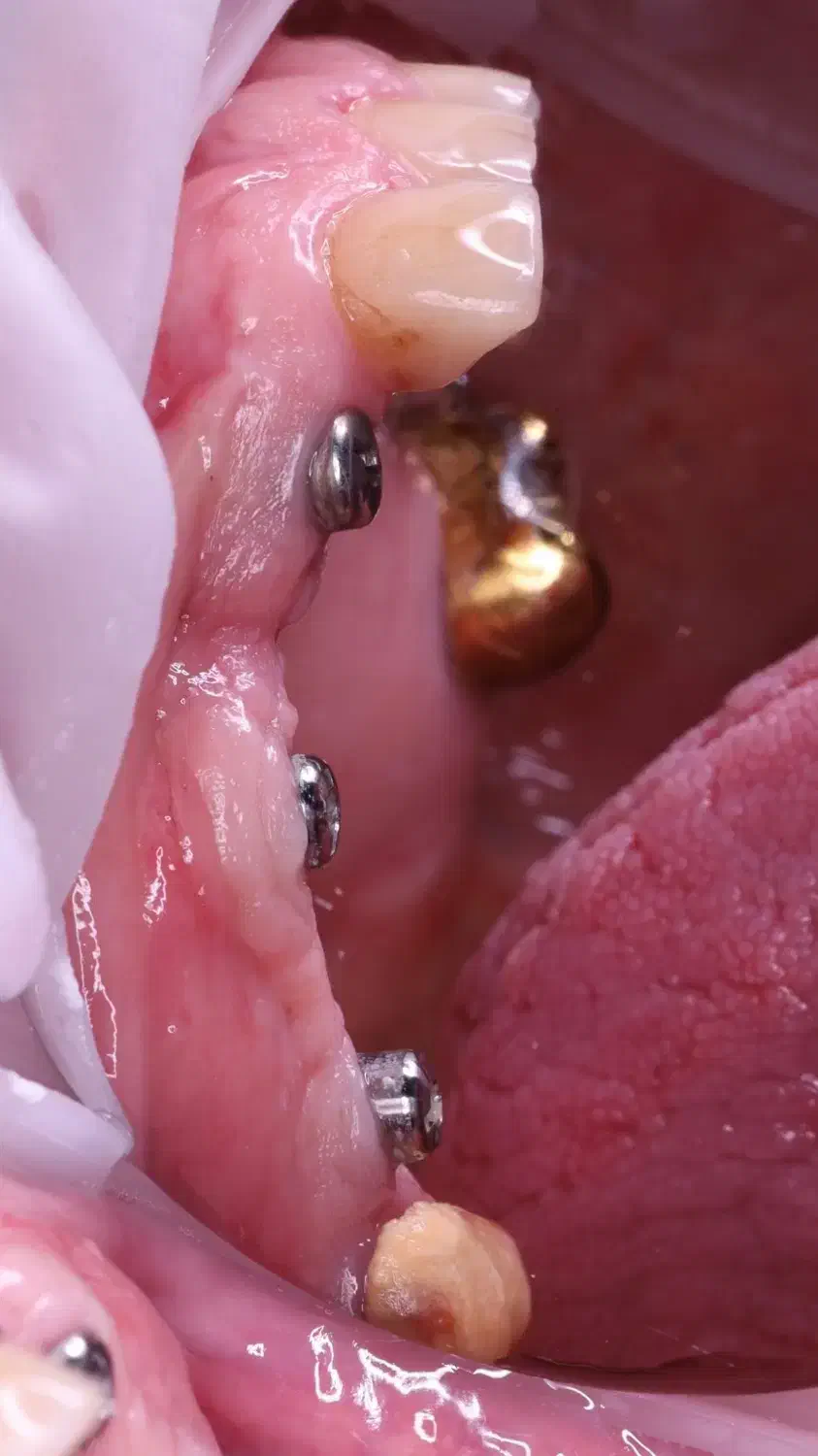 دندانپزشکی ایمپلنت دیجیتال ارتودنسی کامپوزیت لمینت|خدمات آرایشگری و زیبایی|شبستر, |دیوار