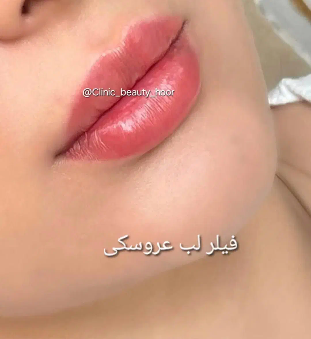 جشنواره تزریق ژل و فیلر بوتاکس کانتورینگ توسط پزشک|خدمات آرایشگری و زیبایی|سنندج, |دیوار