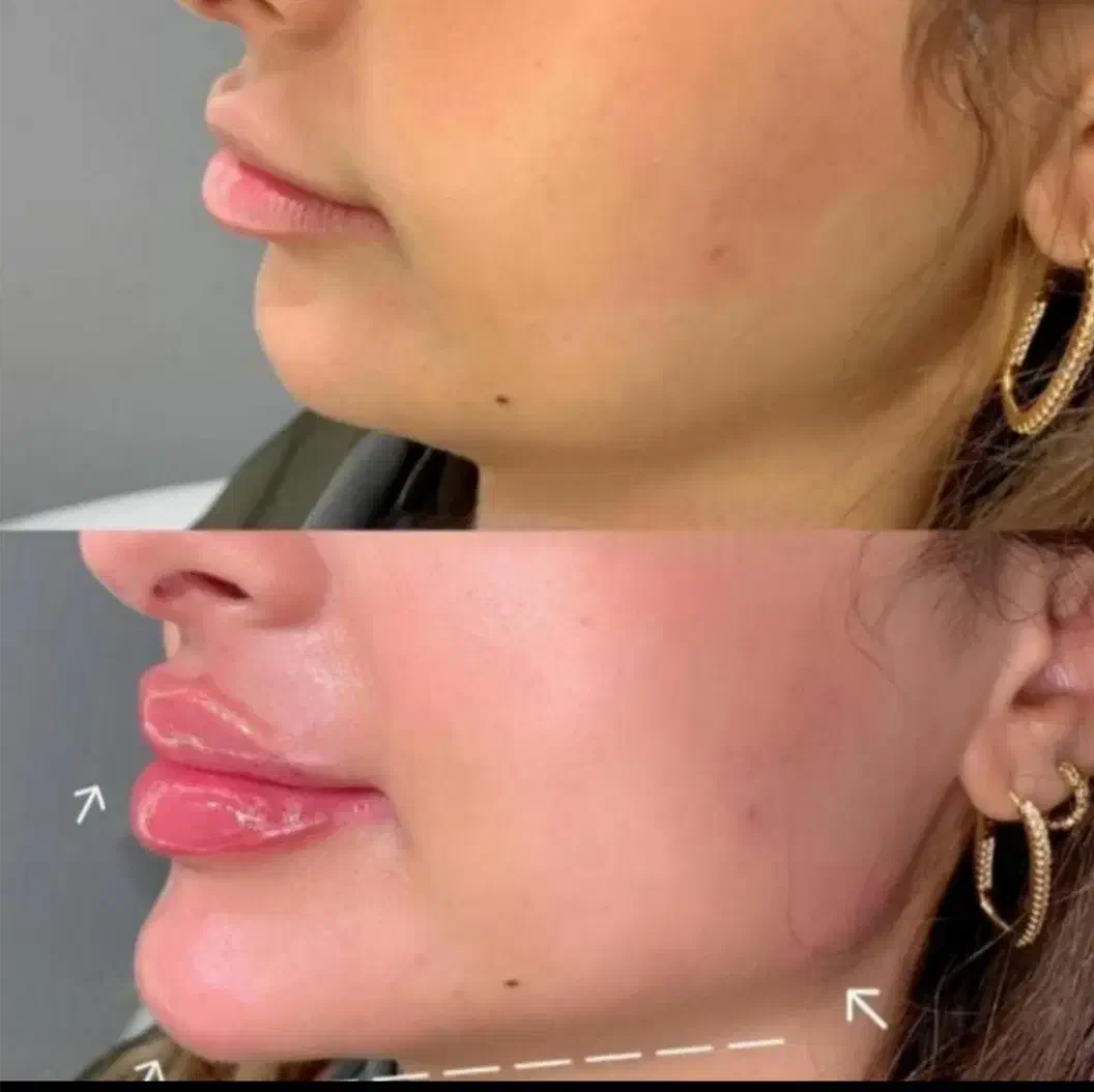 تزریق ژل لب .بوتاکس.لیفت نخ . درمان لک|خدمات آرایشگری و زیبایی|درگهان, |دیوار