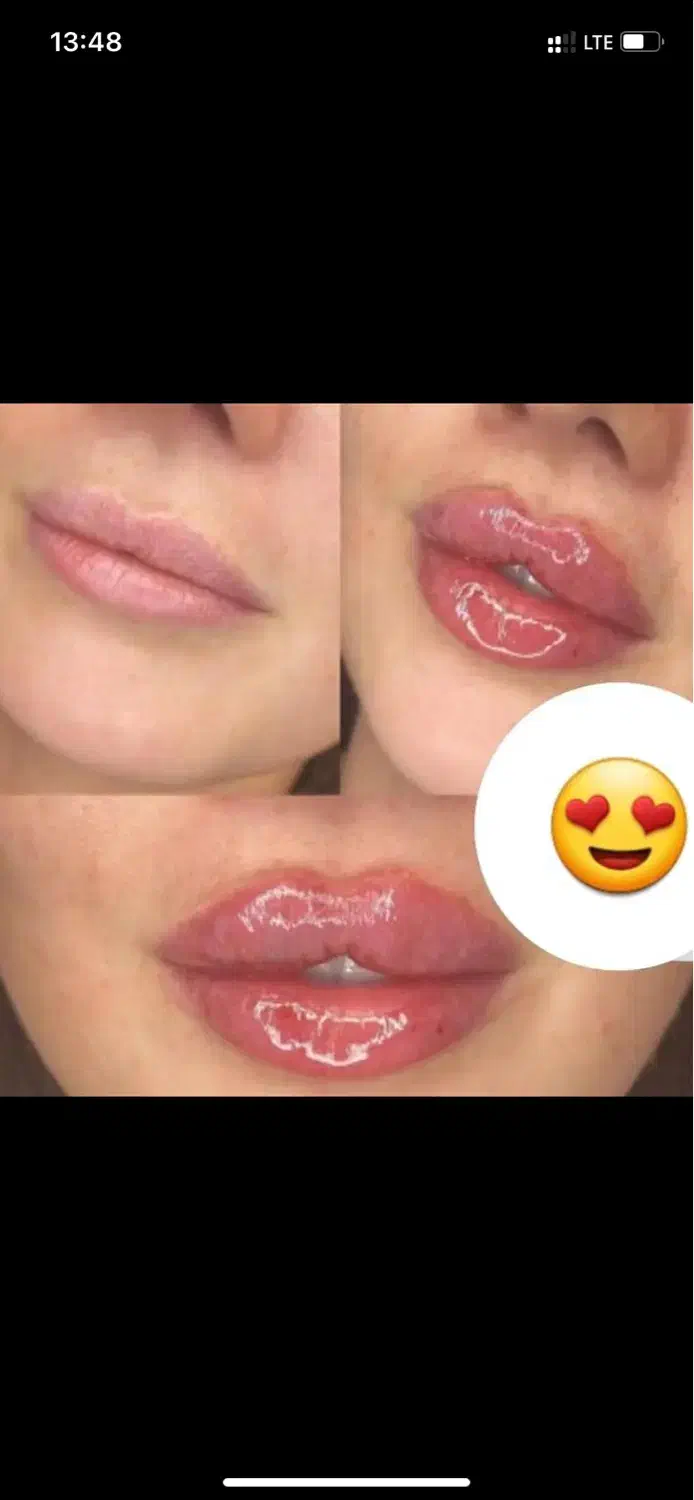 تزریق ژل لب بوتاکس چشم گربه ای لیفت نخ آنزیم|خدمات آرایشگری و زیبایی|تهران, صادقیه|دیوار