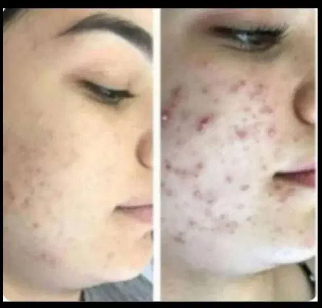 کرم سفید کننده ضدلک وضدجوش اصل سورو|آرایشی، بهداشتی، درمانی|بندرعباس, |دیوار