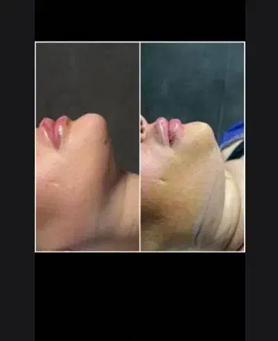 لیپوساکشن،غبغب،لیزرco2|خدمات آرایشگری و زیبایی|شیراز, تلخ داش|دیوار