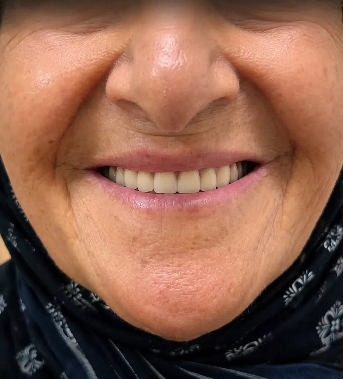 دندان مصنوعی،دندان،دندانسازی،پنجاه درصدتخفیف ویژه|خدمات زیبایی و سلامت|مشهد, پایین خیابان|دیوار