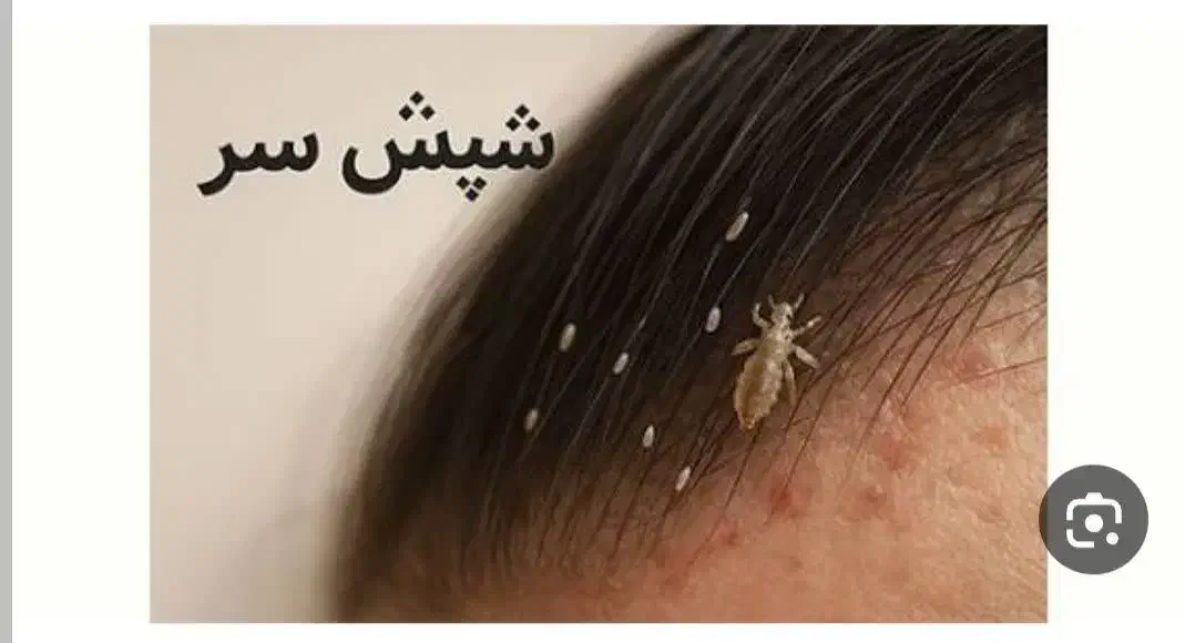 داروشپش.درمان شپش و رشک|آرایشی، بهداشتی، درمانی|گلبهار, شهر جدید گلبهار|دیوار