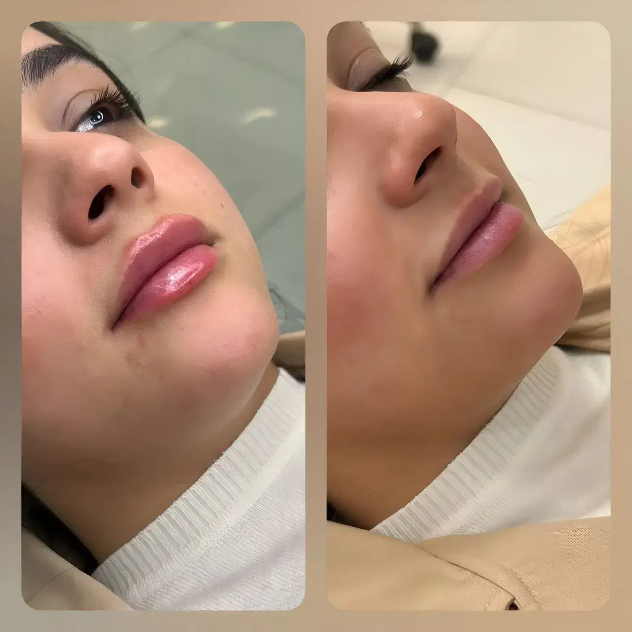 تزریق ژل ،بوتاکس ،لیزر موهای زائد، ساکشن غبعب|خدمات آرایشگری و زیبایی|تهران, صد دستگاه|دیوار