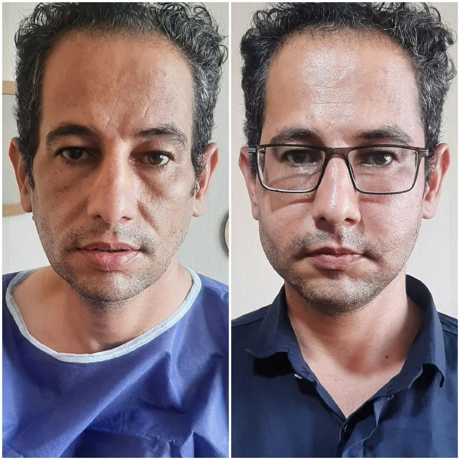 تزریق چربی برای مدت محدود|خدمات آرایشگری و زیبایی|تهران, ایرانشهر|دیوار