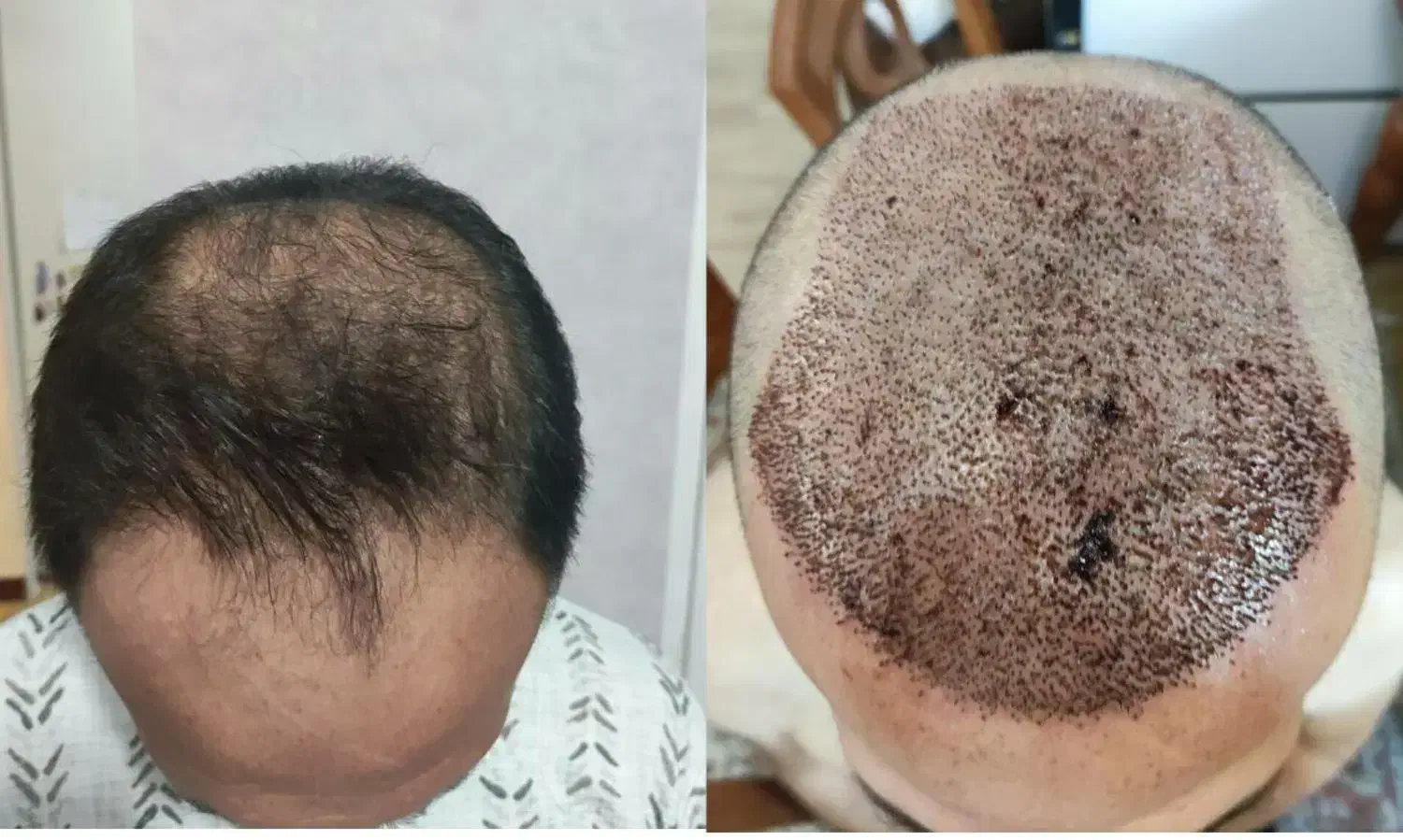 کاشت مو و ابرو|خدمات آرایشگری و زیبایی|تبریز, |دیوار