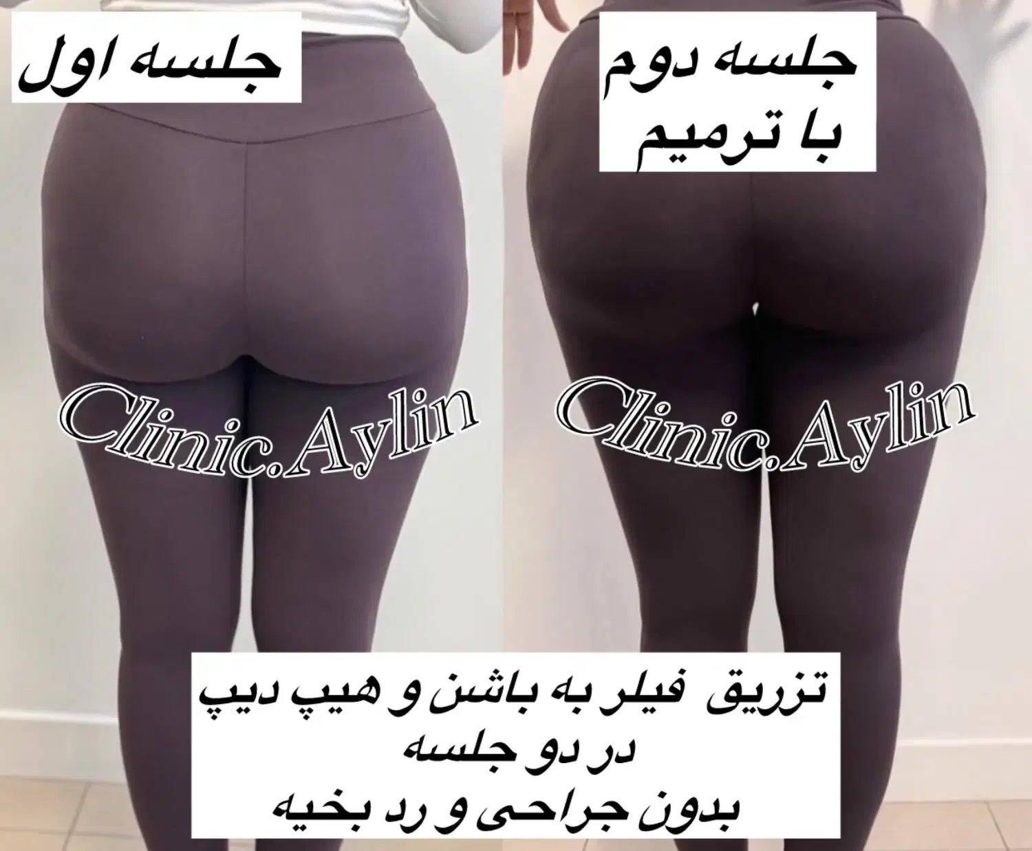 تزریق ژل لب فیلر بوتاکس لیفت فیلربادی کانتورینگ|خدمات آرایشگری و زیبایی|تهران, مرزداران|دیوار