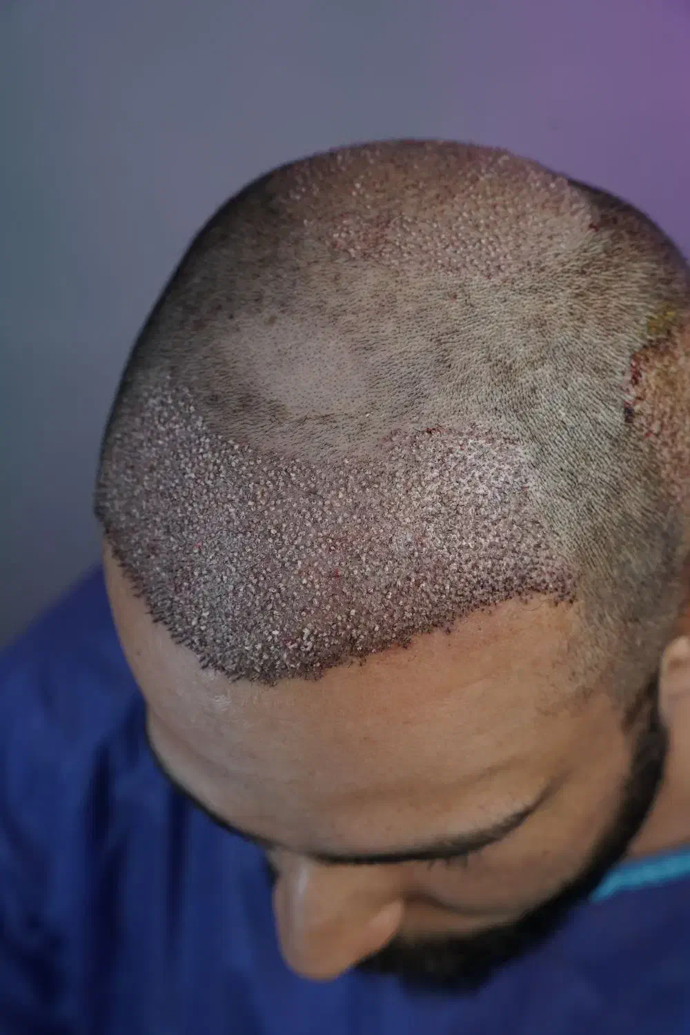 کاشت مو«رویان کاشت»|خدمات آرایشگری و زیبایی|رشت, بوسار|دیوار