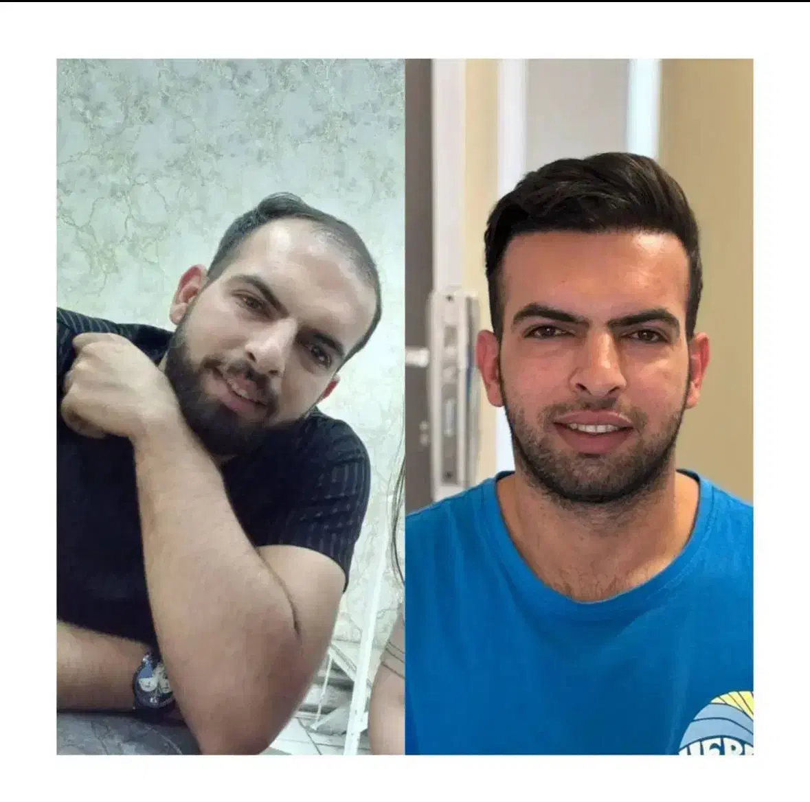 کاشت مو و ابرو شیرازی در اصفهان|خدمات آرایشگری و زیبایی|لنجان, |دیوار