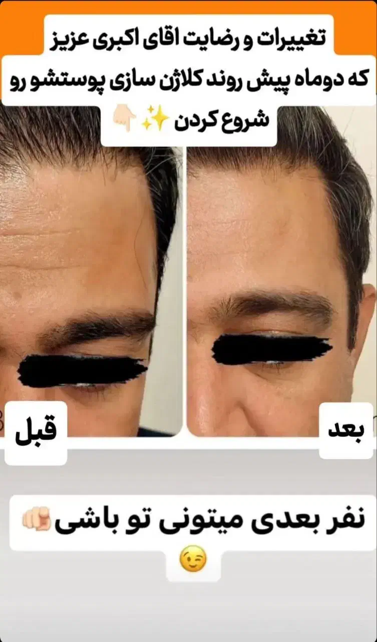 کرم 5 کاره بوتاکس طبیعی|خدمات آرایشگری و زیبایی|گنبد کاووس, |دیوار