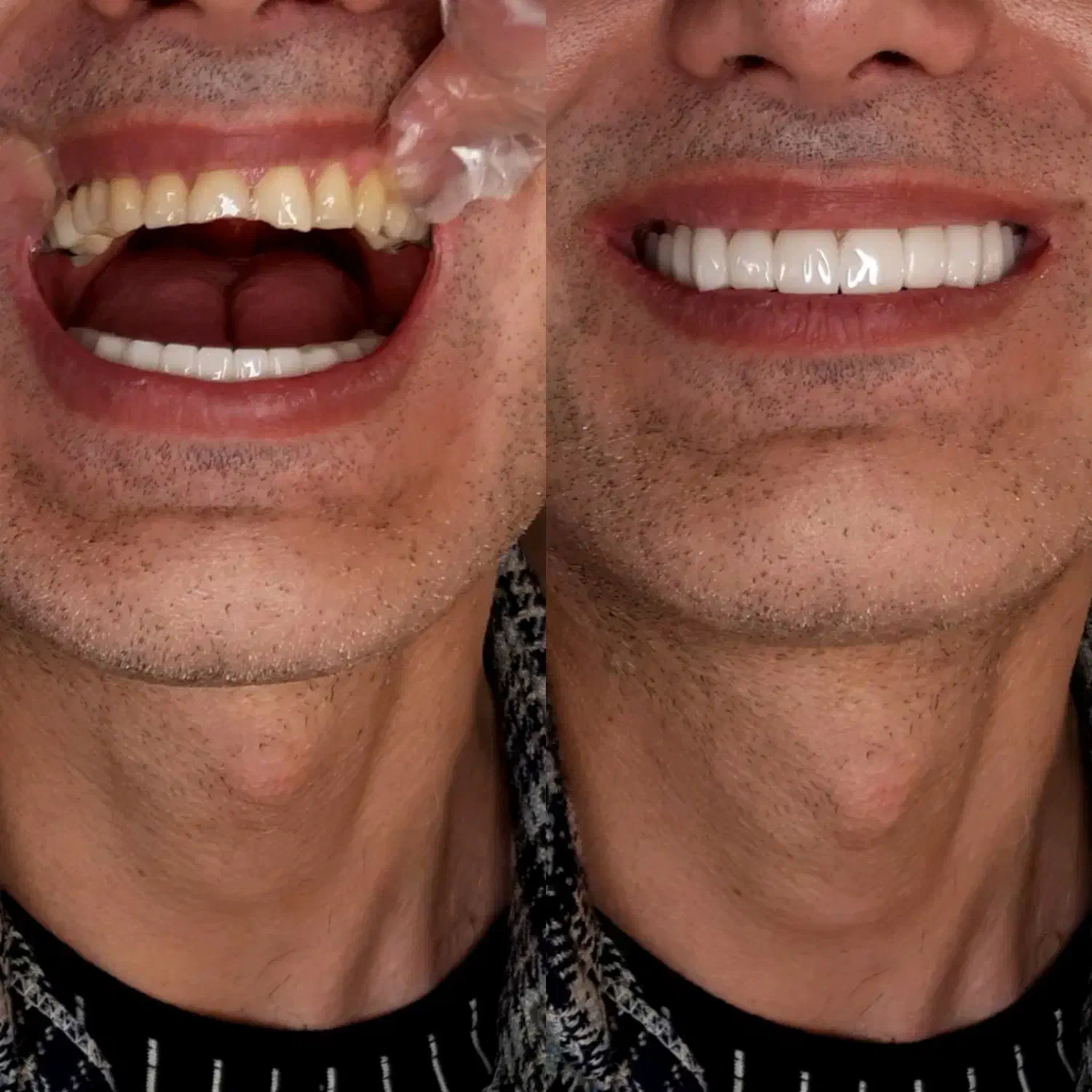 انجام لمینت متحرک دندان|خدمات آرایشگری و زیبایی|تهران, تهرانپارس غربی|دیوار