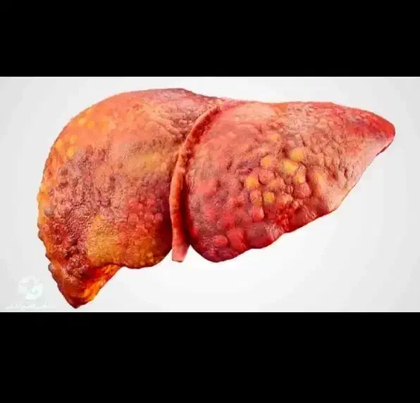 بهبود کبد چرب|آرایشی، بهداشتی، درمانی|کرج, کوی کارمندان شمالی|دیوار