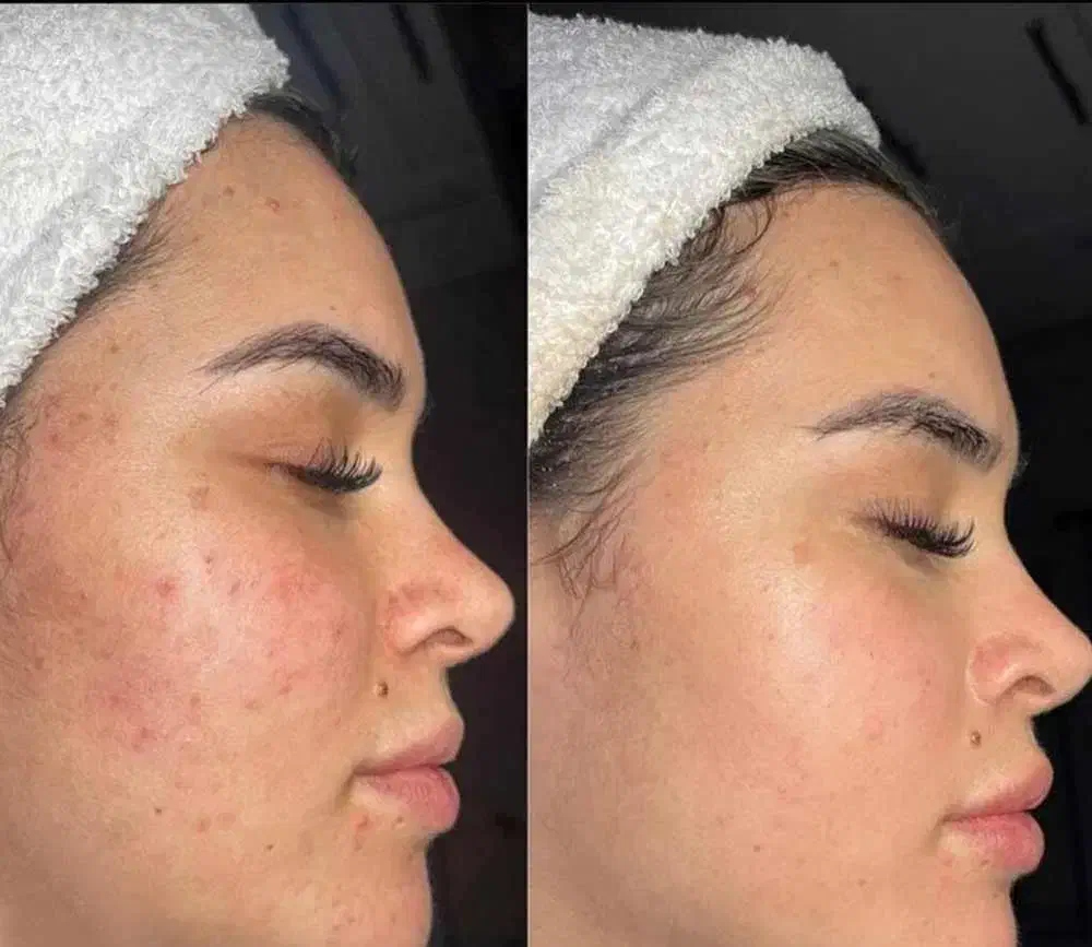 راهنمایی از، بین بردن جای جوش و اسکار|فعالیت داوطلبانه تحقیقاتی|کرمانشاه, |دیوار