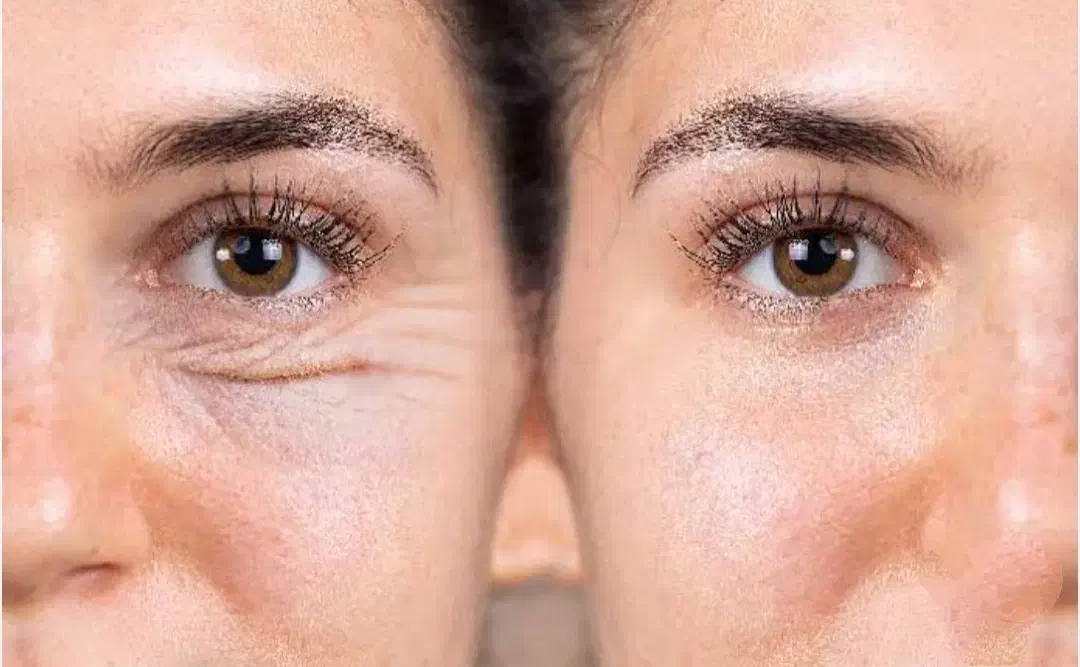 ضد لک جوان کننده|آرایشی، بهداشتی، درمانی|میاندوآب, |دیوار