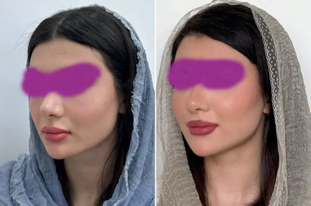 بایو فیلر متد اروپایی کلینیک فرحزاد|خدمات زیبایی و سلامت|اصفهان, عباسآباد|دیوار