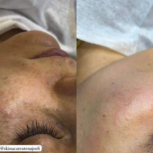 خدمات فیشال و پاکسازی پوست|خدمات آرایشگری و زیبایی|اهواز, زیتون کارگری|دیوار