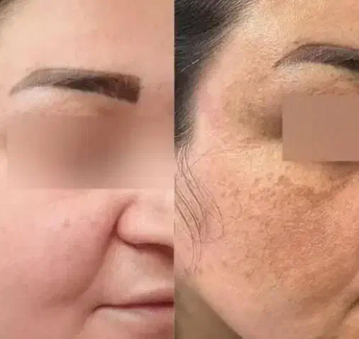برداشتن خال وزگیل|خدمات آرایشگری و زیبایی|کرمانشاه, |دیوار