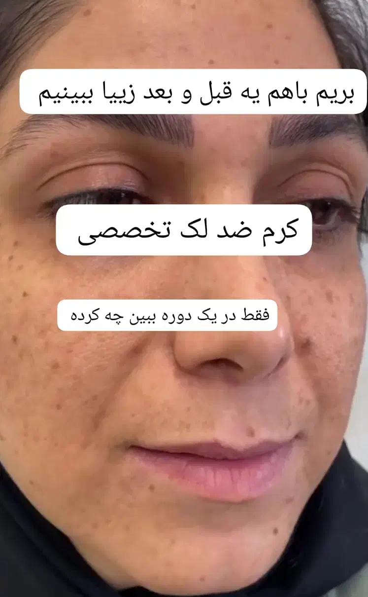 کرم ضد لک تخصصی|آرایشی، بهداشتی، درمانی|ایرانشهر, |دیوار