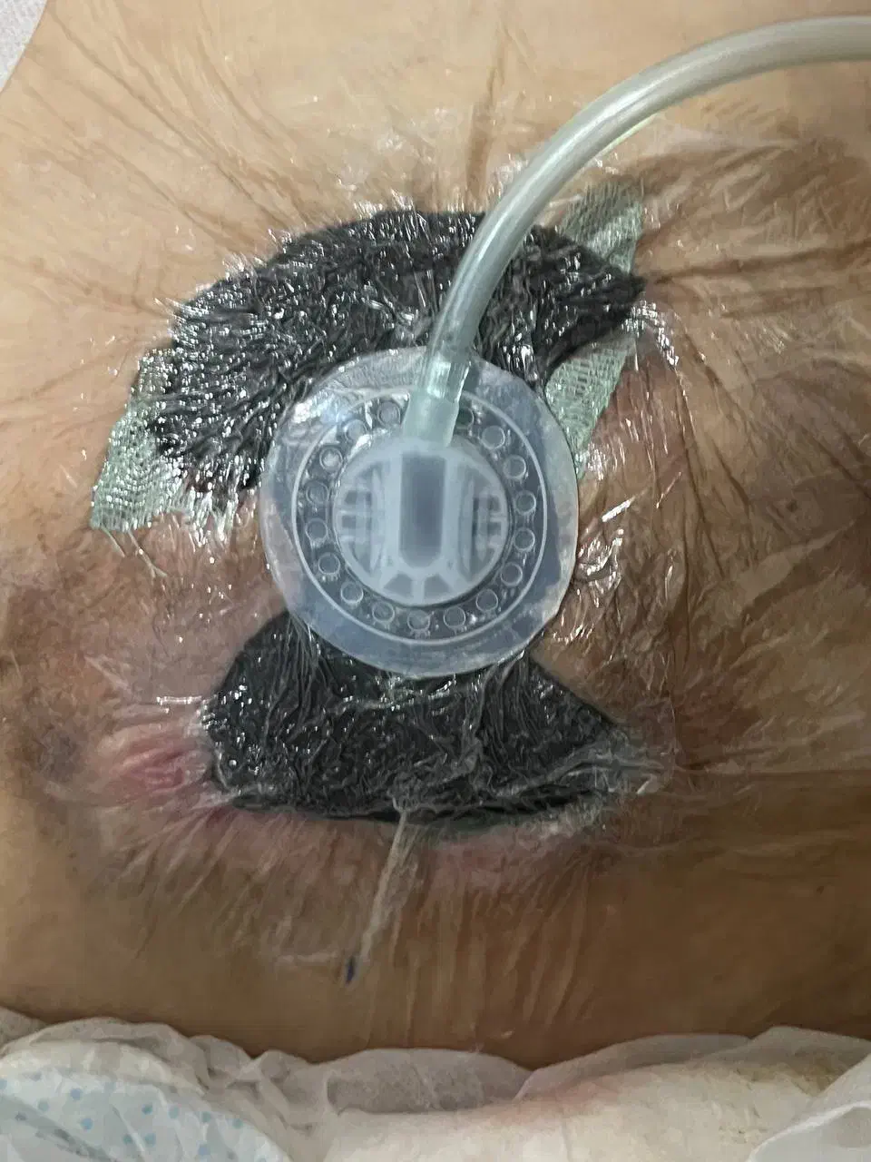 پانسمان نوین زخم بستر / دیابتی / سوختگی / سرطانی|خدمات آرایشگری و زیبایی|ارومیه, |دیوار