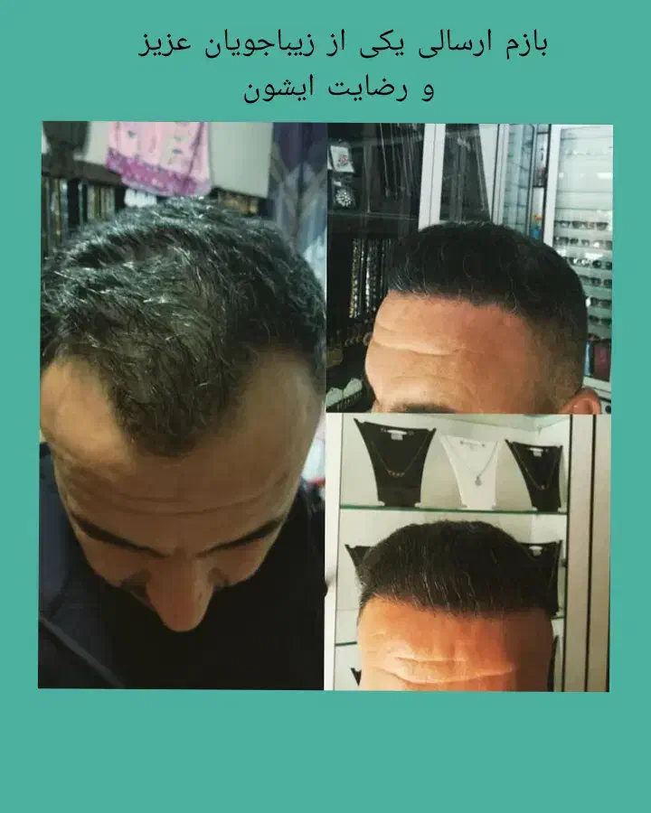 کاشت موی طبیعی دوباره جذاب شو مثل روز اول|خدمات آرایشگری و زیبایی|یزد, |دیوار