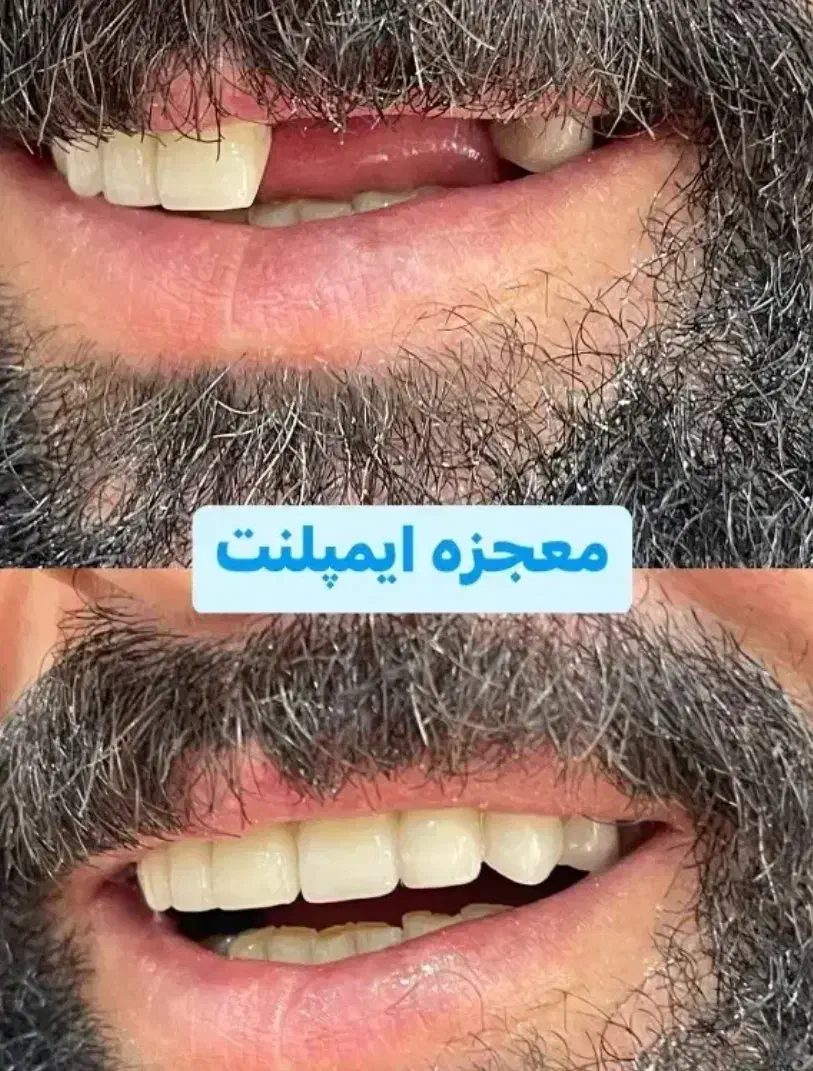ایمپلنت فوری فقط۱۰۳۰۰/دندانپزشکی با اقساط۶-۱۵ماهه|خدمات آرایشگری و زیبایی|ملکان, |دیوار