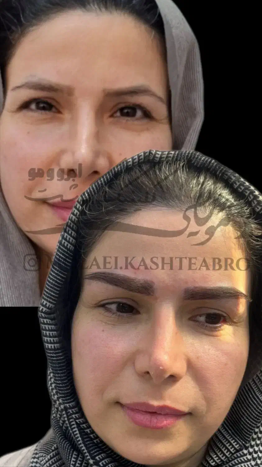 کاشت ابرو تخصصی در درمانگاه معتبر|خدمات آرایشگری و زیبایی|اهواز, زیتون کارمندی|دیوار