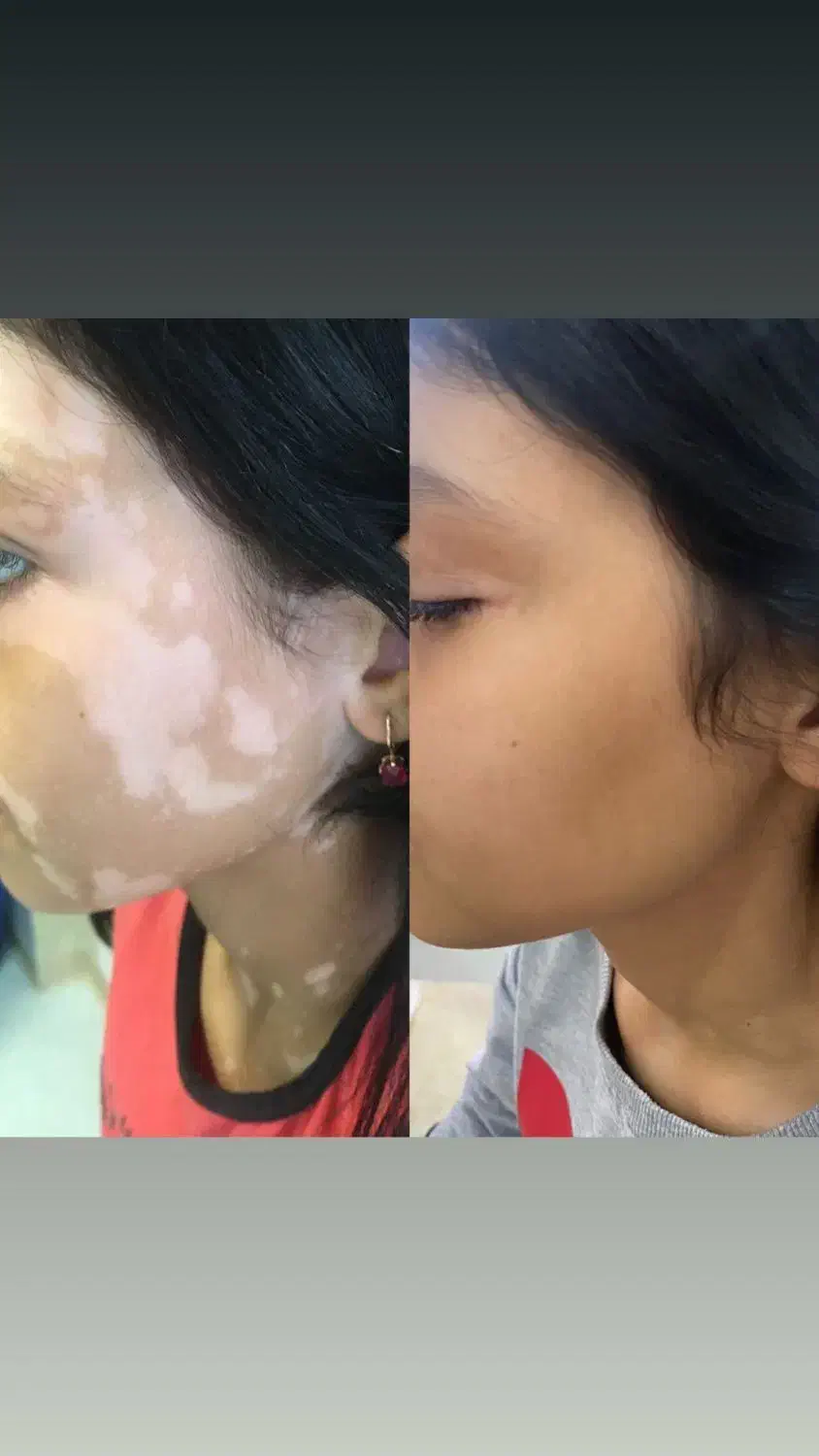 درمان قطعی و بدون بازگشت مشکلات پوستی|خدمات آرایشگری و زیبایی|مشهد, کلاهدوز|دیوار