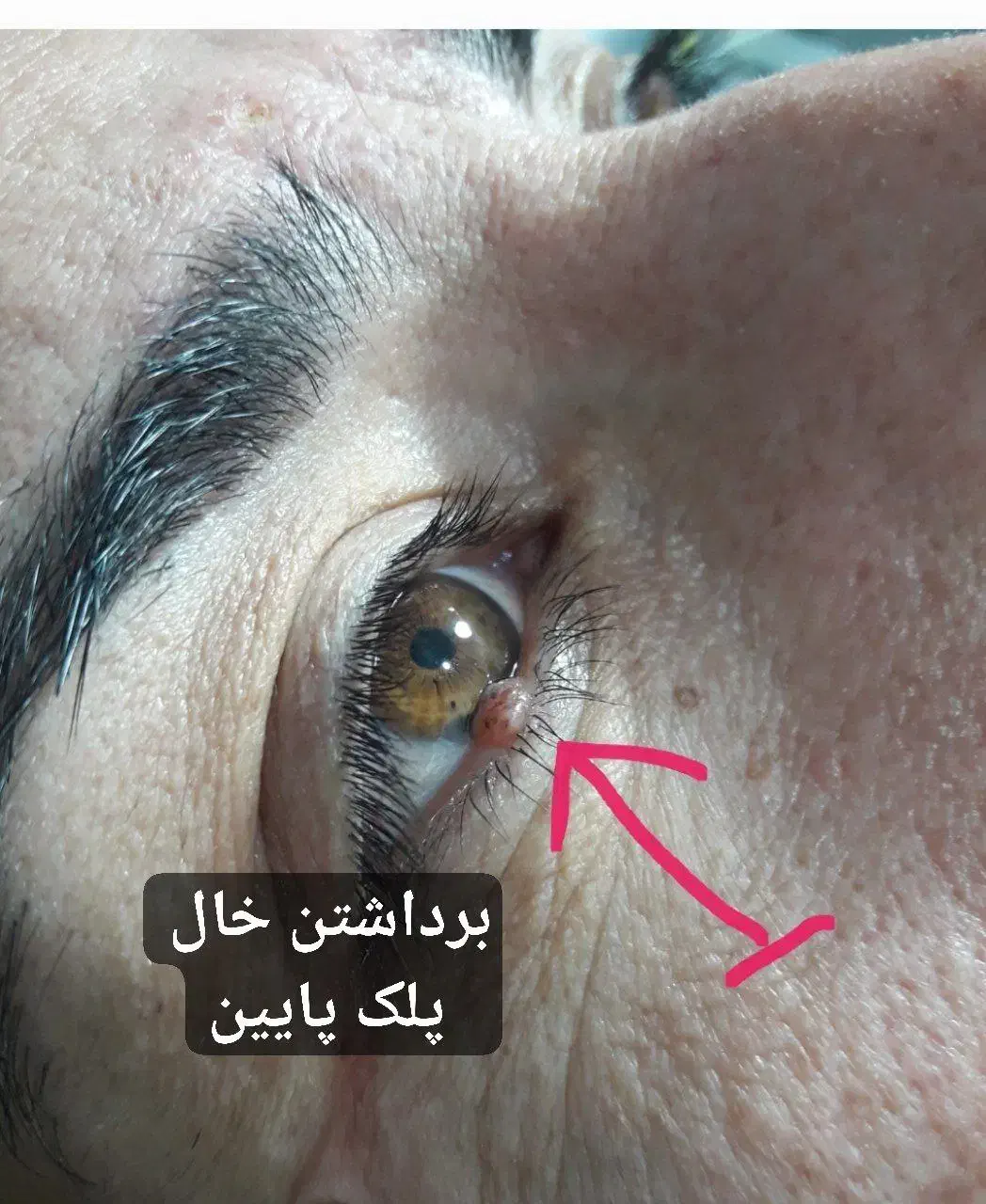 برداشتن خال ، زگیل ، میخچه، جراحی و بوتاکس در مطب|خدمات آرایشگری و زیبایی|تویسرکان, |دیوار