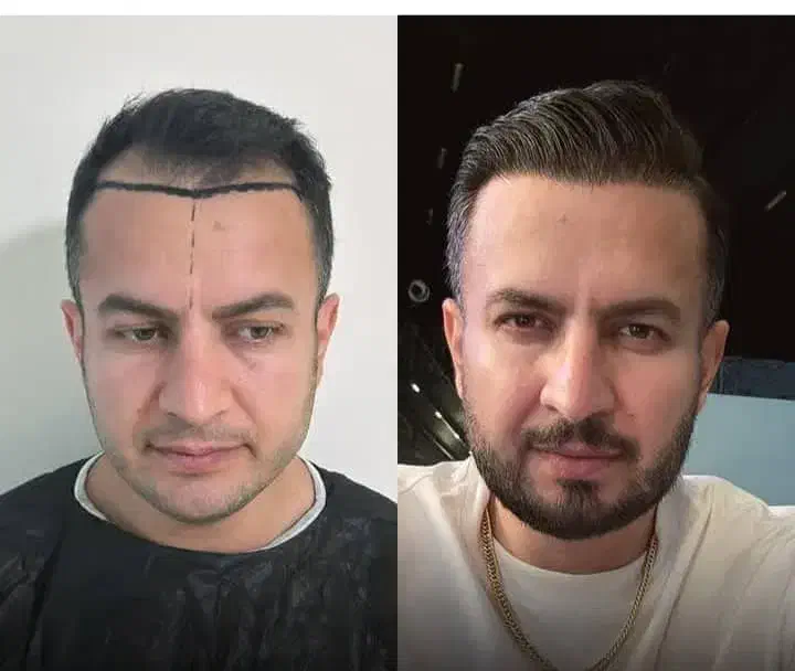 جشنواره پاییزه کاشت مو و کاشت ابرو|خدمات آرایشگری و زیبایی|تهران, دردشت|دیوار