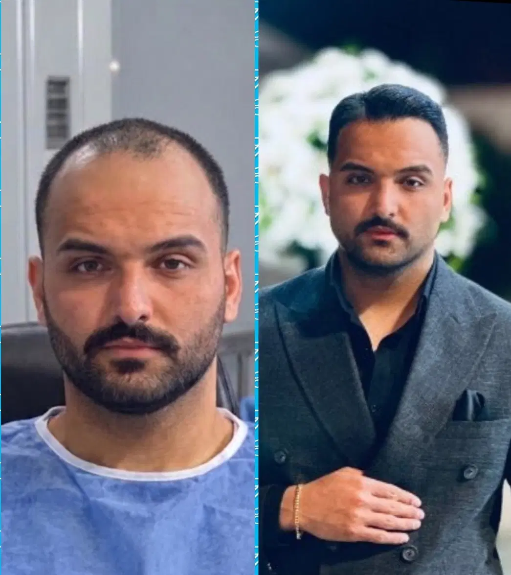 جشنواره کاشت مو طبیعی با تراکم بالا (حتی اقساط )|خدمات زیبایی و سلامت|تهران, جماران (نیاوران)|دیوار