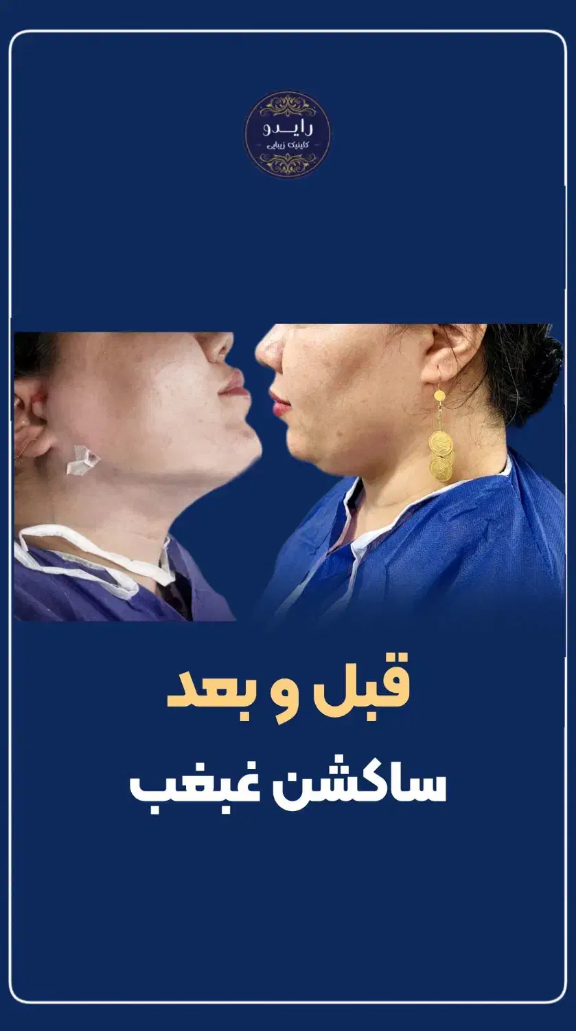 تزریق چربی ،ساکشن غبغب،پی ارپی مو ،مزو زگیل میخچه|خدمات آرایشگری و زیبایی|یاسوج, |دیوار